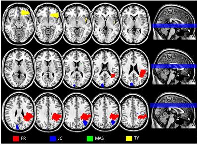 Dissociation between Semantic Representations for Motion and Action Verbs: Evidence from Patients with Left Hemisphere Lesions